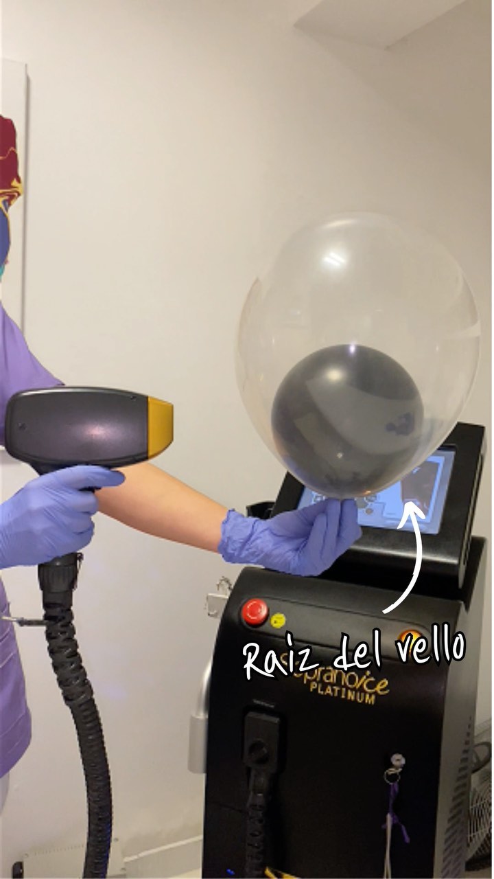 El equipo Soprano Ice Platinum de INTUS y una operadora con guantes lila que muestra, con un globo, cómo el láser llega a la raíz del vello